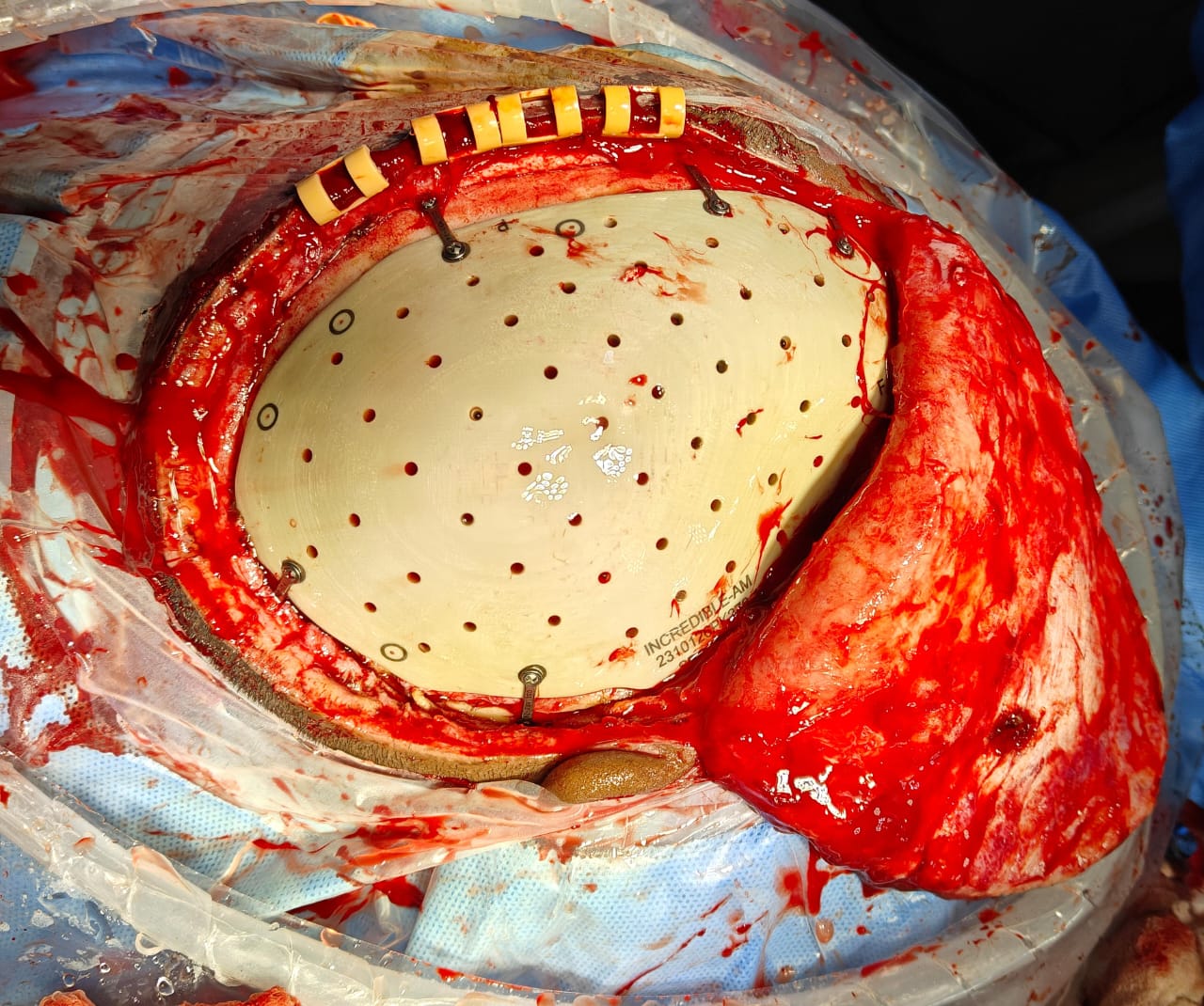 PEEK Cranial Implant