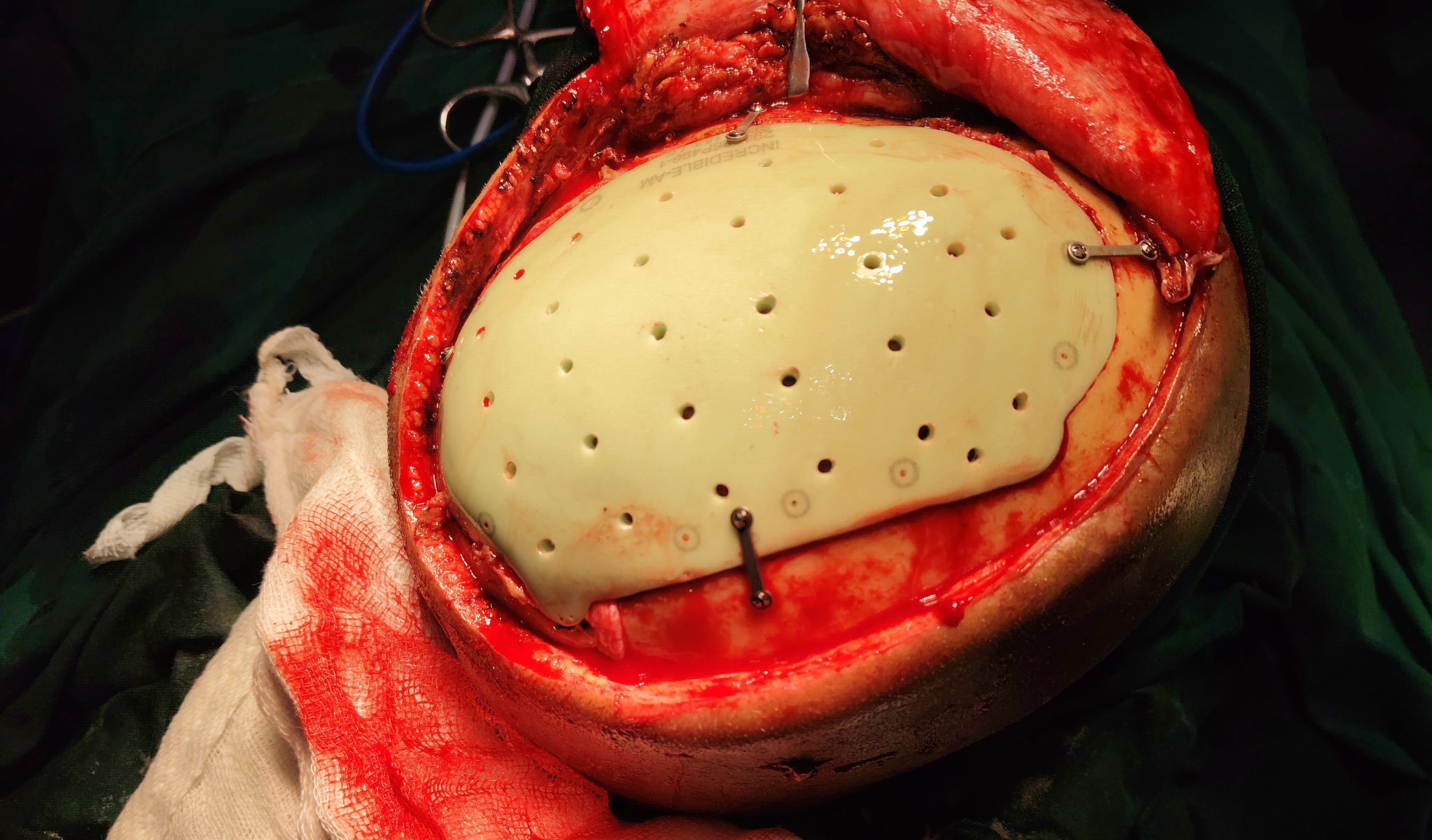 PMMA Cranial Implant