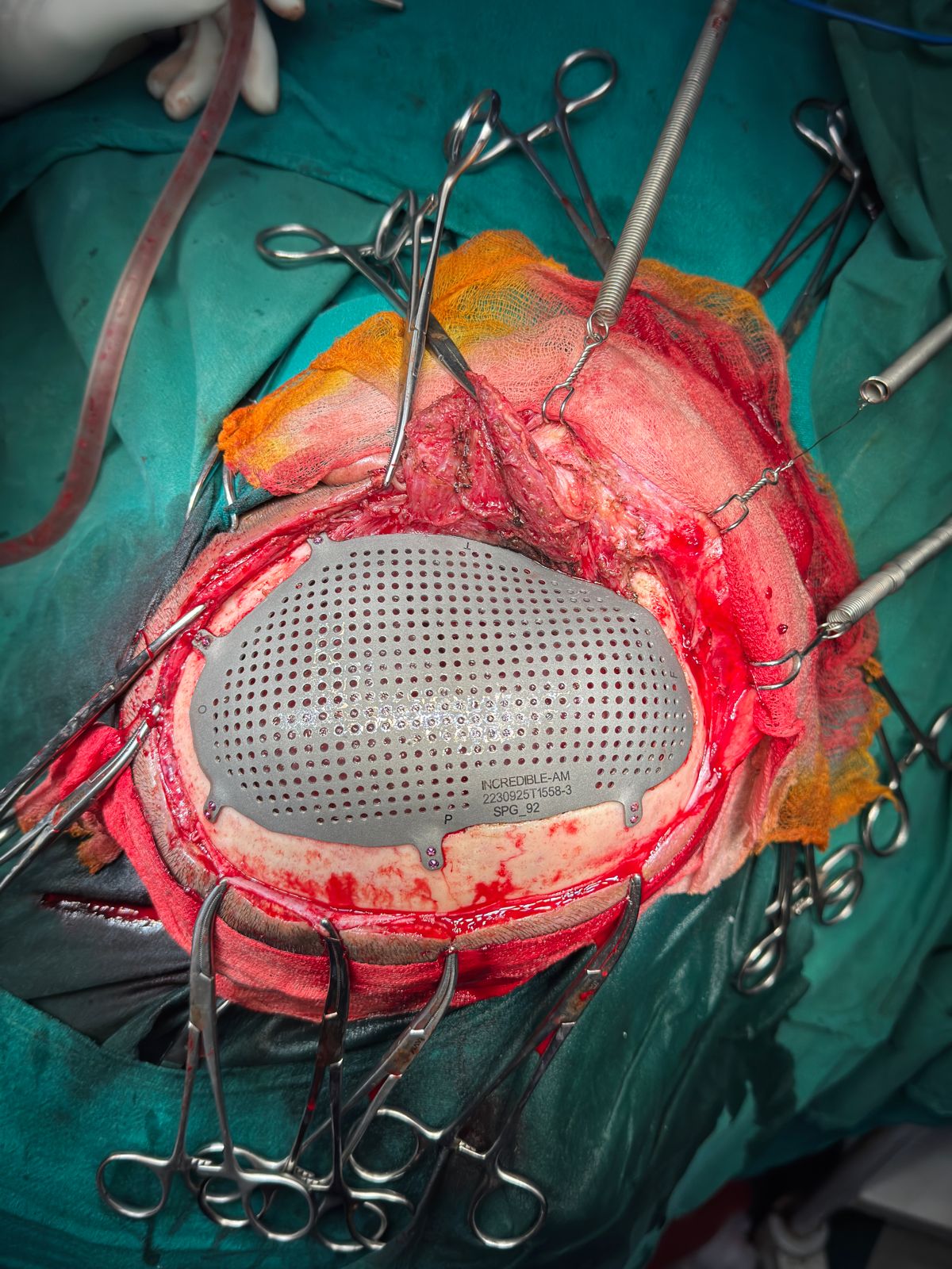 Titanium Cranial Implant (Ti-6Al-4V)
